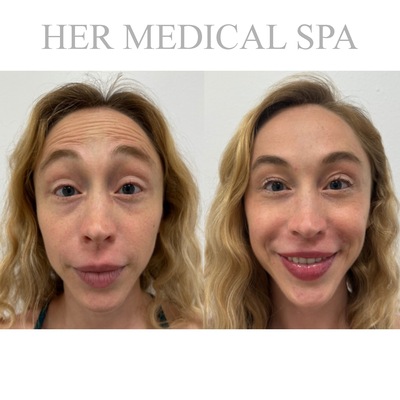 botox/xeomin patient photo