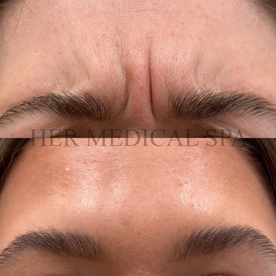 botox/xeomin patient photo