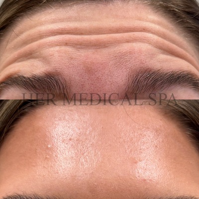 botox/xeomin patient photo