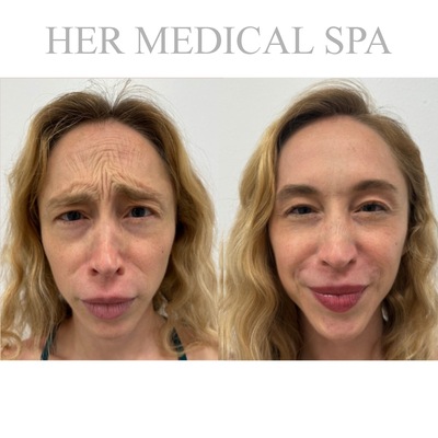 botox/xeomin patient photo