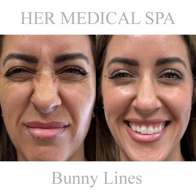 botox/xeomin patient photo