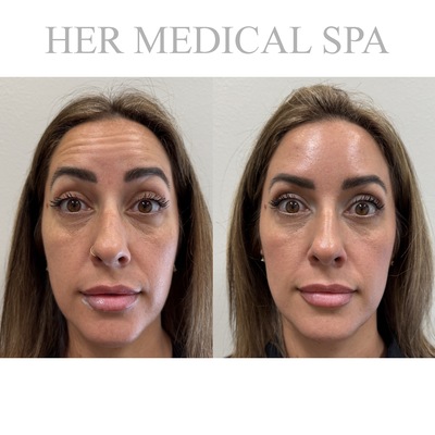 botox and/or xeomin patient photo before and after 