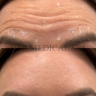 botox and/or xeomin patient photo before and after 