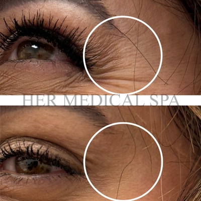 botox and/or xeomin patient photo before and after 