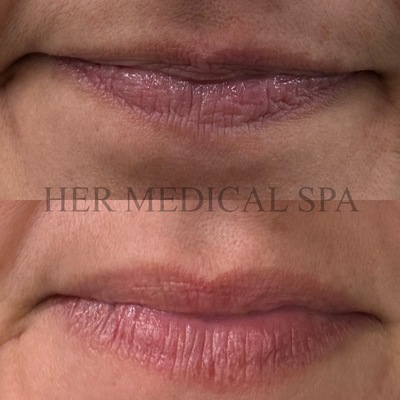botox and/or xeomin patient photo before and after 