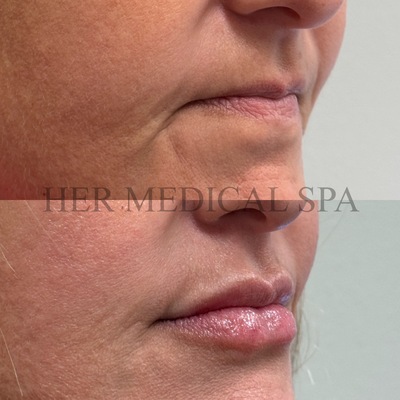 Picture of before and after lip filler of a patient