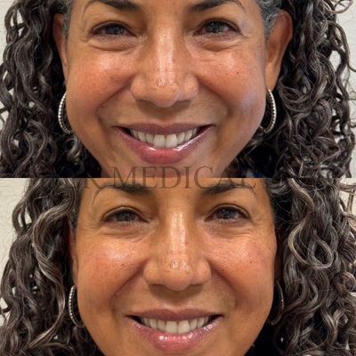 Picture of before and after mid-face/cheek filler of a patient