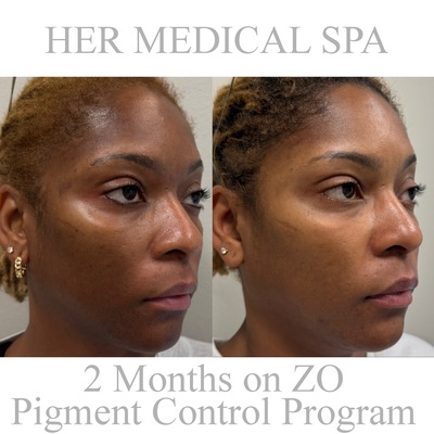 photo of before and after zo pigment control prgram