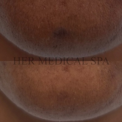 photo of before and after zo pigment control prgram