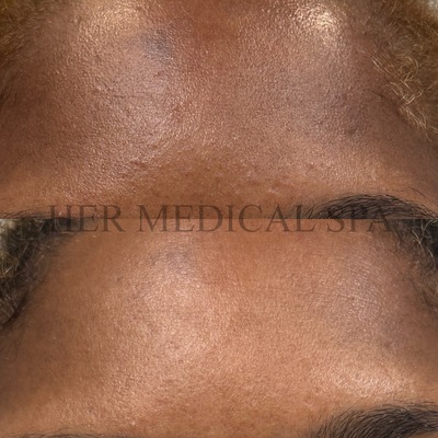 photo of before and after zo pigment control prgram